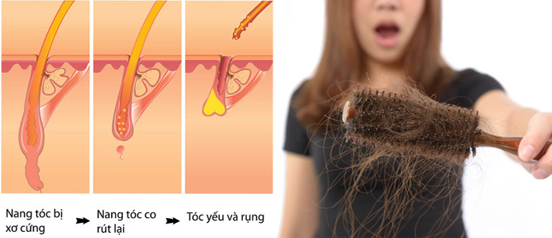 Bệnh rụng tóc ở phụ nữ