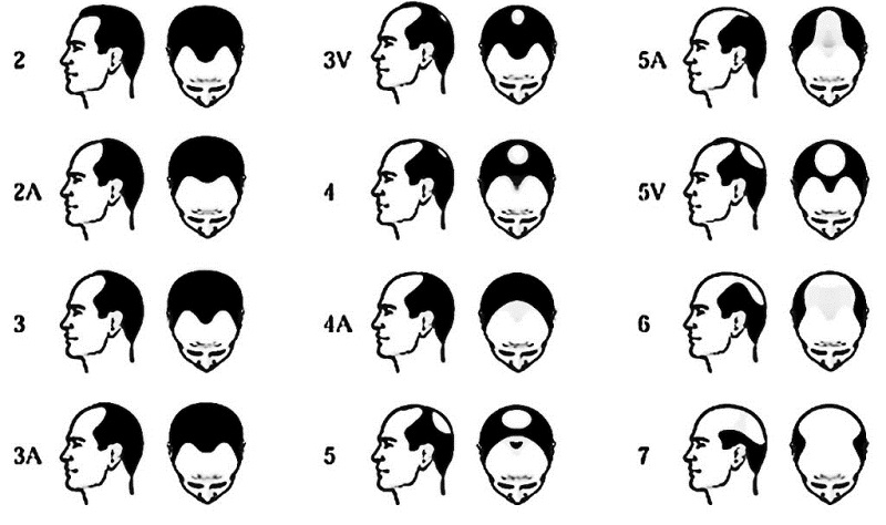 Quá trình rụng tóc Androgen ở nam giới