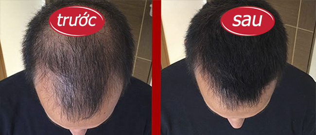 Trước và sau khi dùng Strong Hair
