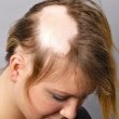Rụng tóc hói đầu ở nữ chữa sao cho hết?