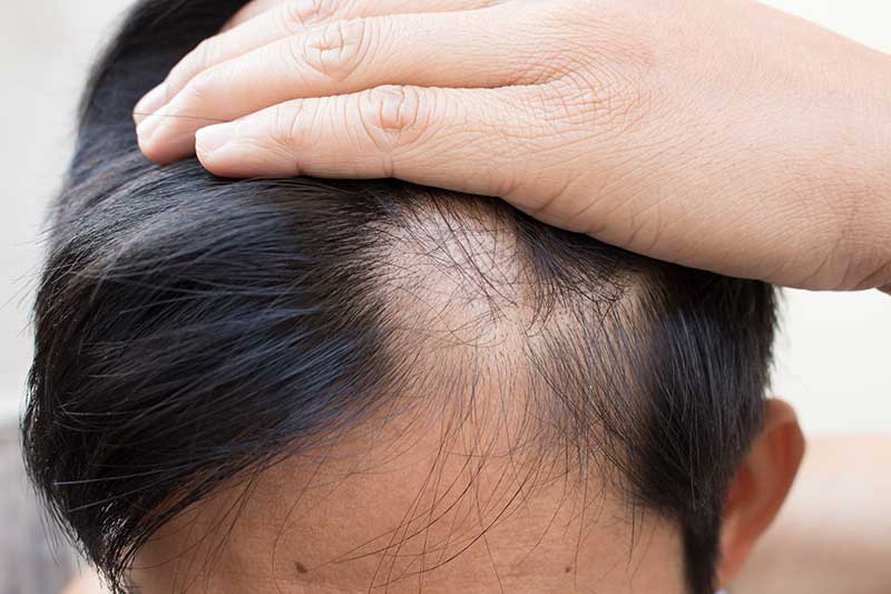 Rụng tóc nhiều có phải bị ung thư