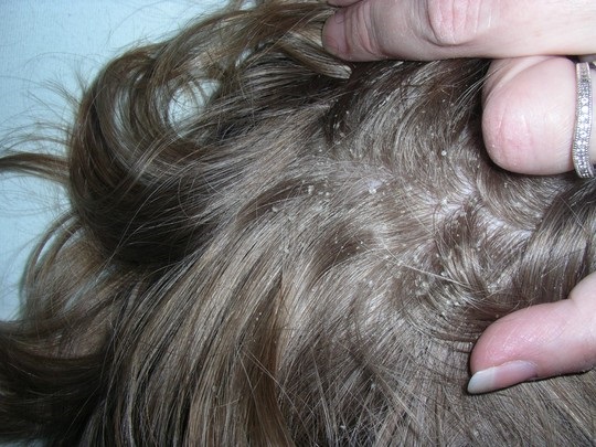 Tóc rụng có hạt trắng là bệnh gì