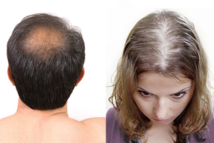 Rụng tóc nhiều xảy ra cả nam và nữ