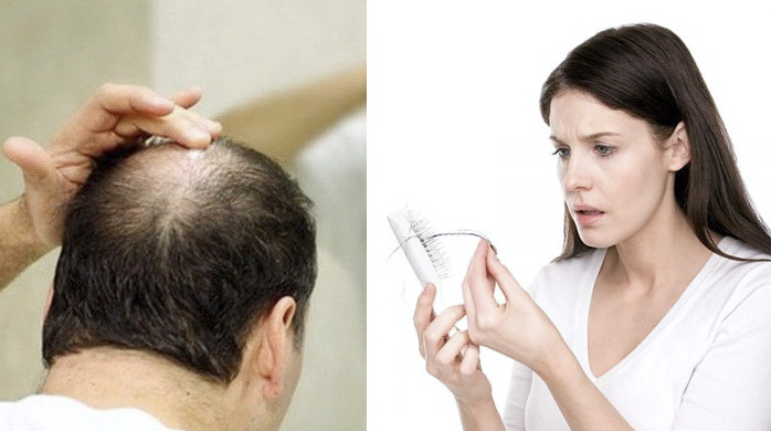 cách chữa rụng tóc hiệu quả nhất