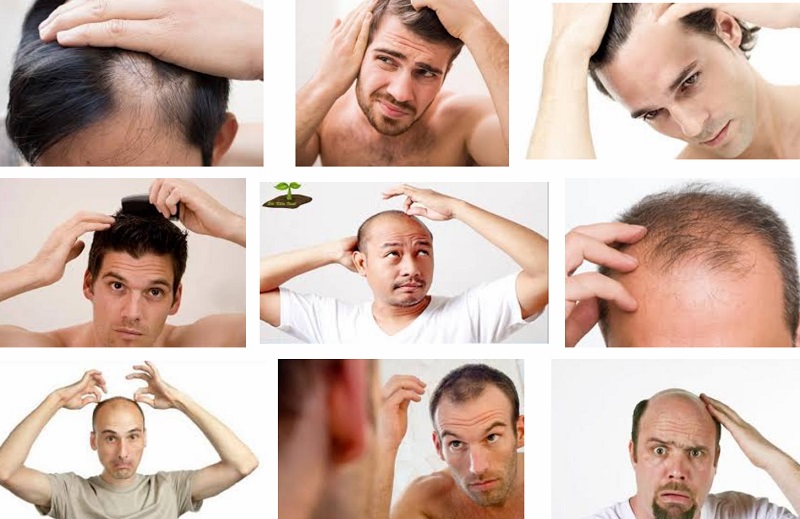 Rụng tóc quá nhiều ở nam giới