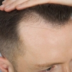 Các nguyên nhân gây rụng tóc ở nam giới, nam giới tóc rụng nhiều