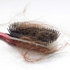 Những dấu hiệu rụng tóc nhiều bạn nên biết để điều trị sớm