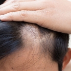 Rụng tóc hói đầu bệnh không nguy hiểm nhưng khó chữa