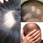 Rụng tóc pelade là gì và làm sao chữa khỏi?