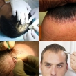 3 cách chữa rụng tóc không sẹo hiệu quả