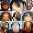 3 nguyên nhân rụng tóc từng mảng và cách điều trị