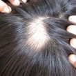 Tóc rụng nhiều ở đỉnh đầu làm sao để chữa hết?