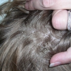 Tóc rụng có hạt trắng là bệnh gì? Nguy hiểm đến mức nào?