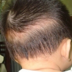 Trẻ rụng tóc sau gáy là bệnh gì có nguy hiểm không?
